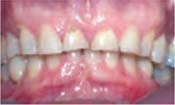 Tooth Wear/Bruxism