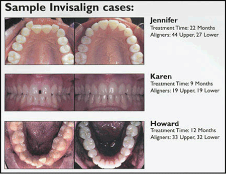 Invisalign Sample Cases