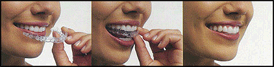 Invisalign How-To