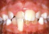 Anterior Crossbite